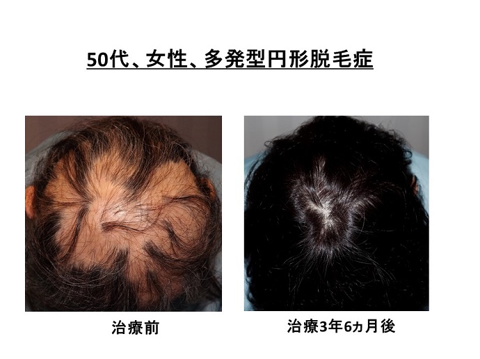 円形脱毛症　病院